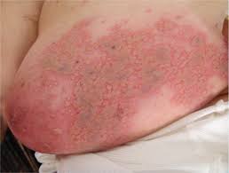 Hsv 1&2 negative after 14 months of exposure. Widespread Tender Hemorrhagic Patches On The Breast Photo Quiz American Family Physician