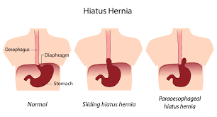 Image result for Hernia Reduction