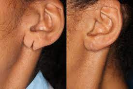 A complicated repair is more expensive than a simple earlobe repair. Earlobe Repair Washington Dc Center For Laser Surgery