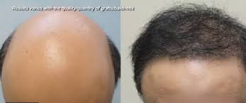However, it will again depend on the size of the area that needs to be treated and the number of grafts required. Beard Hair Transplant Cost Dermhair Clinic L A 1 310 318 1500