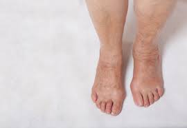 Traveling spells out joy for a lot of people. How To Stop Legs From Swelling On A Long Flight Starts At 60