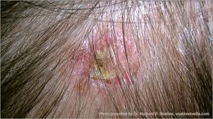 (some doctors use the term atypical mole to refer to a dysplastic nevus.) a … Skin Cancer Pictures Photos Pictures Of Skin Cancer