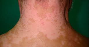 Las personas con vitíligo pueden correr un mayor riesgo de que suceda lo siguiente: Informacion Sobre El Vitiligo Todo Lo Que Debes Saber