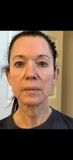 I am new to the group but have learned a lot from reading here thus far.  I'm 67 and had a virtual consultation with a surgeon in NC. I submitted the  photos