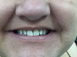 Mar 02, 2021 · katie price. Veneers Smile Studio