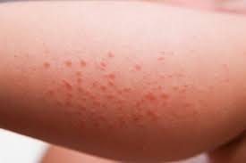 Causes And Natural Remedies For Itchy Red Bumps On The Arms Enkimd