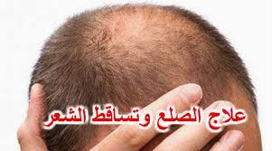 أعشاب لعلاج الصلع وإنبات الشعر من جديد بطرق منزلية بسيطة المعلومة