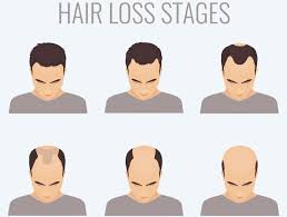 Glatte frisuren sind keine kontraindikation für dünnes haar, wie die meisten männer denken. Dunner Werdendes Haar Haarausfall Bei Mannern Ursachen Behandlungen Nioxin