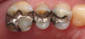 Maybe you would like to learn more about one of these? Berikut Jenis Jenis Dari Tambal Gigi Beserta Harganya Fdc Dental Clinic
