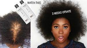 The feedback on nioxin is providing enough buzz to make people wonder if it actually works as good as they've heard it does. 3 Weeks Update On Nioxin System 1 For Fine Thin Hair Ogc Youtube