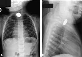 However, in order to find a valuable treasure, you need to find spots with a high likelihood of having hidden treasures. Foreign Body Ingestion And Aspiration American Academy Of Pediatrics