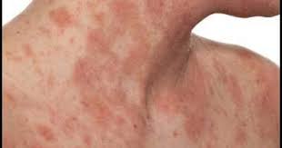 Eczematous Dermatitis Or What We Call Eczema Is A Skin Disease Which Starts From Itchiness And Ends Up With Red Eczema Remedies Home Remedies For Eczema Eczema