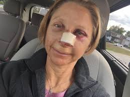 I've had 8 days of posterior epistaxis (nose bleed). Blood is super warm  and Steady stream. Comes with no warnings, harder to stop than anterior  epistaxis. Probably not PGC related just another