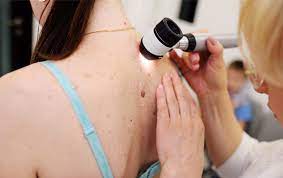 Diagnosing melanoma on the nail. Non Melanoma Skin Cancer Information Oncobeta