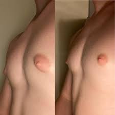 puffy nips in room temp vs cold for those wondering what gyno looks like. I  am 17 : r gynecomastia