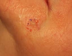 It's commonly found on your face, chest, arms, and hands. Disease Management Nonmelanoma Skin Cancer