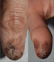 Image result for Acral lentiginous melanoma nail
