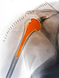 Reverse Shoulder Replacement Surgery Repairs Rotator Cuff Tears Reverse Shoulder Replacement Shoulder Replacement Surgery Rotator Cuff Tear
