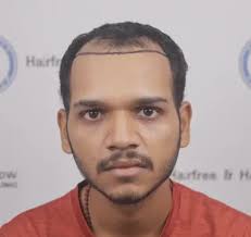 Hair Transplant in Chandigarh