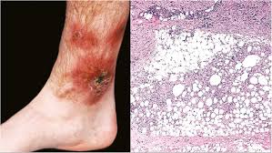 Image result for Panniculitis