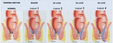Artikel ini membincangkan simptom, tanda dan punca buasir. Buasir Thrombosed Apa Yang Anda Perlu Ketahui Sihat Net