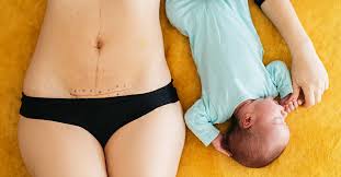 This is done to prevent the chances of vomiting. I Couldn T Pee And Other Things I Didn T Expect After My C Section