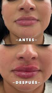 Baby botox en paciente de 39 años, primera vez que se realiza toxina  botulinica.