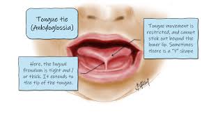 Image result for Ankyloglossia