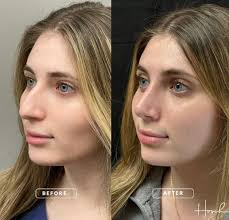 Blepharoplasty upper eyelid lift by @drarihosch! Blepharoplasty is a  surgical procedure to improve the appearance of the eyelids. Surgery can be  performed