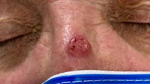 Image result for skin cancer on nose pimple
