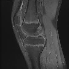 The medial condyle is one of the two projections on the lower extremity of femur, the other being the lateral condyle. Osteochondritis Dissecans Of The Medial Femoral Condyle With A Mcl Tear And Radial Tear Of The Phmm Radiology Case Radiopaedia Org