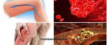 En efecto, se origina en el sustantivo θρόμβωσις (pr. Tromboembolismo Definicion Sintomas Causas Diagnostico Y Tratamiento Arriba Salud