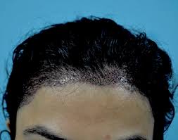 Alopecia areata (an autoimmune condition that causes hair loss) telogen effluvium (temporary hair loss that's usually caused by stress or shock) Female Pattern Hair Loss A Comprehensive Review Bertoli 2020 Dermatologic Therapy Wiley Online Library