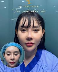 ✓Rhinoplasty surgery for a customer in Vietnam has just been completed 👍.  The nose was deformed due to rhinoplasty surgery at an unreliable address.  Let's see and compare the revision cases that