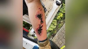 Image result for spinne biss haut reaktion