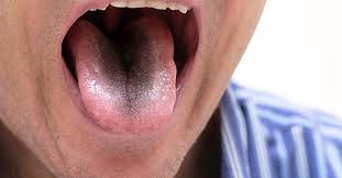 Image result for black hairy tongue symptoms