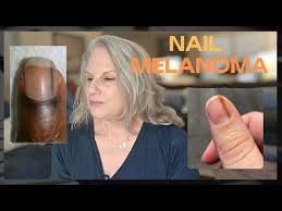 Image result for Acral lentiginous melanoma nail