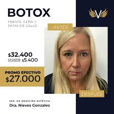 Procedimiento realizado por la Dra. Nieves Gonzalez, Especialista en  Medicina Estética. Si estás buscando: ⚡ suavizar arrugas relacionadas con  el envejecimiento ⚡ eliminar líneas de expresión del mal humor, el estrés y