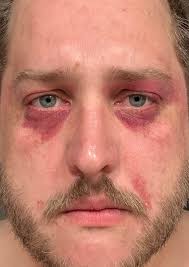 I have nose sores inside my nose that won't heal. I'm looking for a product  that would help this. It's been going