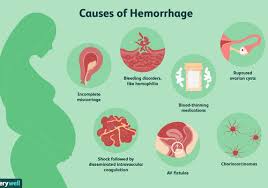 How To Know If You Re Hemorrhaging Due To A Miscarriage