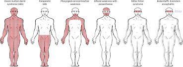 Gbs affects about one or two people each year in every 100,000 population. Mimics And Chameleons In Guillain Barre And Miller Fisher Syndromes Practical Neurology