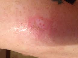 Identifying Insect Bites Stings
