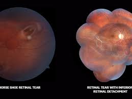 Check spelling or type a new query. Retinal Tear Symptoms Causes And Treatment