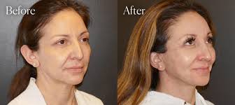Facial Plastic Surgeon in Denver, CO
