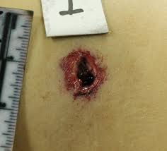 The determination of the shooting hand provides important clues about the perpetrator. Figure Figure 2 Exit Wound Statpearls Ncbi Bookshelf