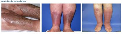 Image result for Lipodermatosclerosis