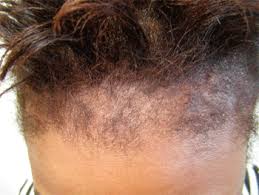 Hair regrowth + thickening oils include argan, saw palmetto, pumpkin. Emu Oil For Hair Growth
