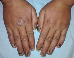 Image result for Anhidrosis