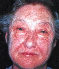 Dermatomyositis The Lancet What do you know about antibiotics?