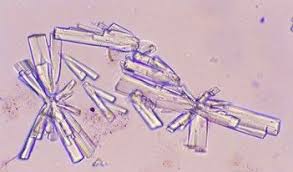 Pour préserver les cristaux d'urate de sodium sur les pièces anatomiques, on doit utiliser non pas des fixateurs hydroformolés et usuels mais l'alcool absolu qui or, plus bas est le ph urinaire, plus faible est la proportion d'urate de sodium dans l'urine et plus forte celle d'acide urique libre, 17 fois moins. Urine Crystals Soidum Urate Medical Laboratory Science Medical Laboratory Scientist Medical Laboratory